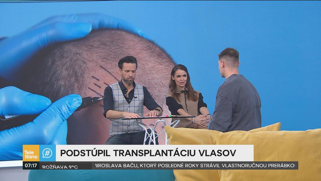 Martin Koči rozprával v Teleráne o transplantácii vlasov.