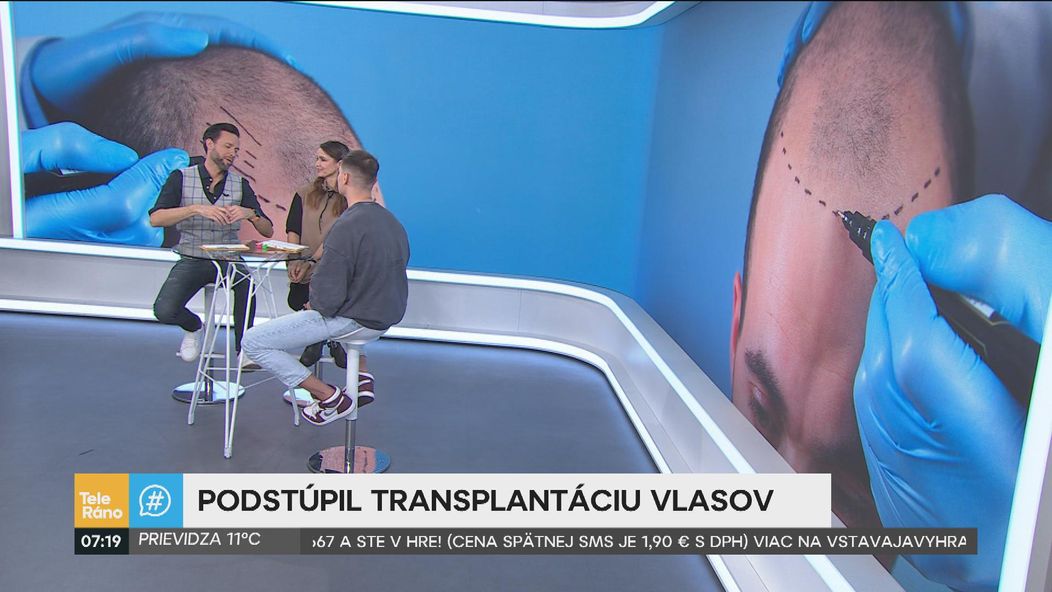 Martin Koči rozprával v Teleráne o transplantácii vlasov.