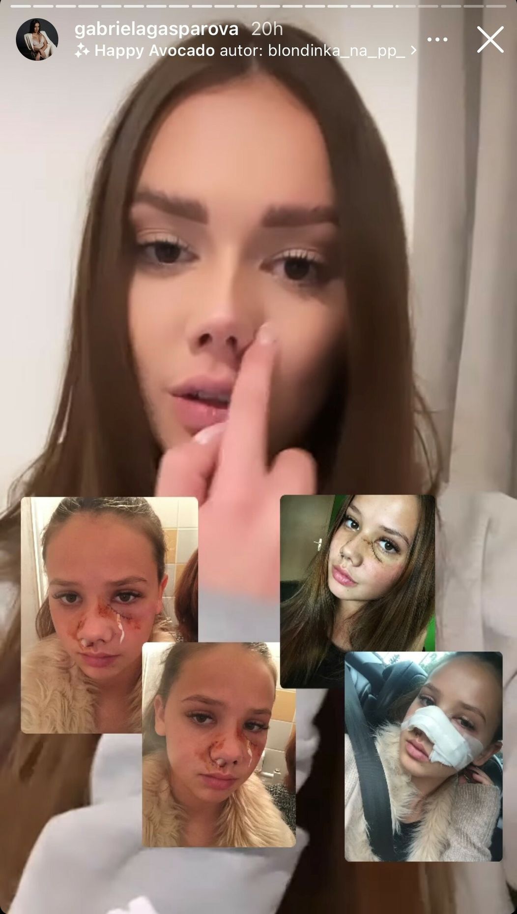 Gabriela ukázala hrozivé fotky po útoku psa.