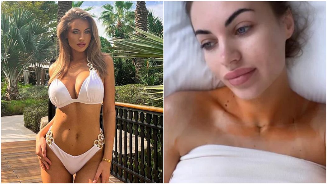 Natálie Kočendová pred a po zmenšení poprsia.