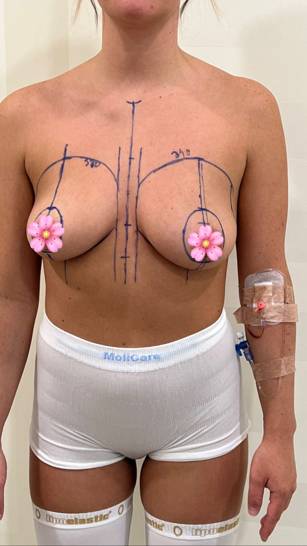 Tereza po plastickej operácii