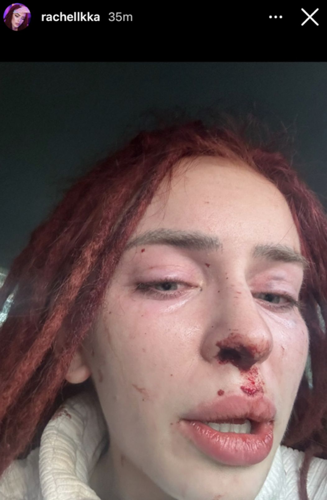 Ráchel Karnižová zverejnila fotky po bitke a správy plné vulgarizmov
