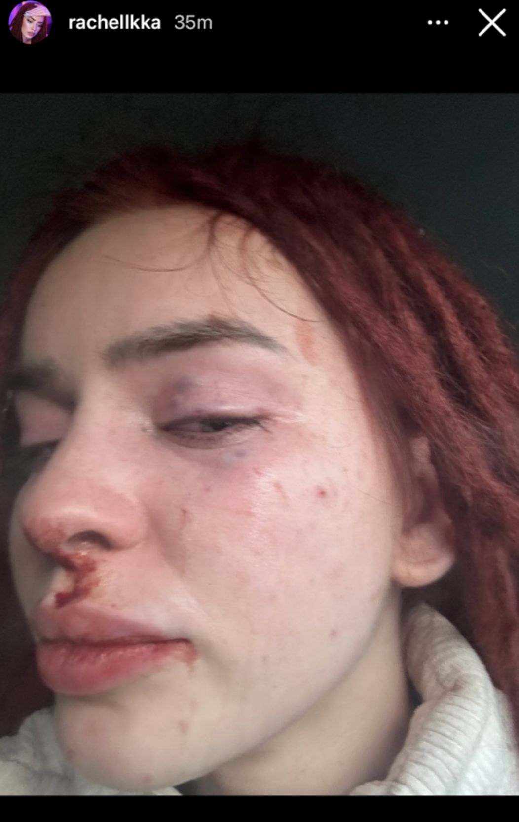 Ráchel Karnižová zverejnila fotky po bitke a správy plné vulgarizmov