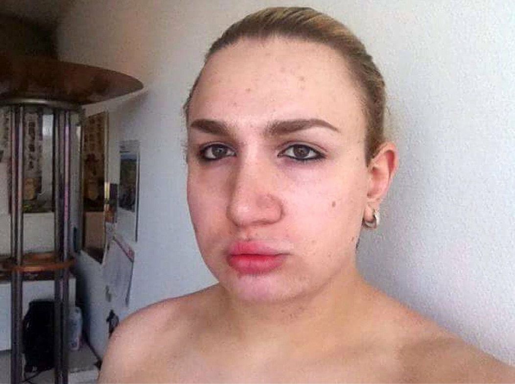 Ivana Vladislava pred odstránením silikónu.