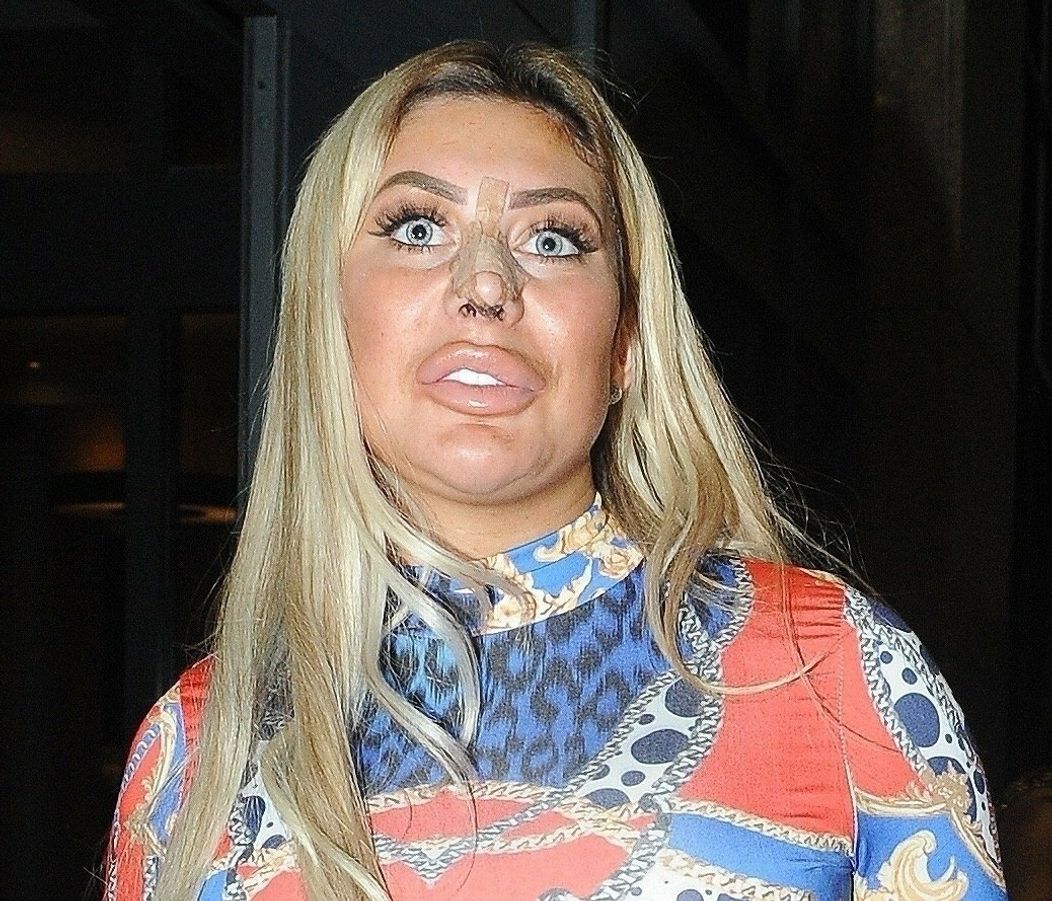 Chloe Ferry po plastike nosa. 