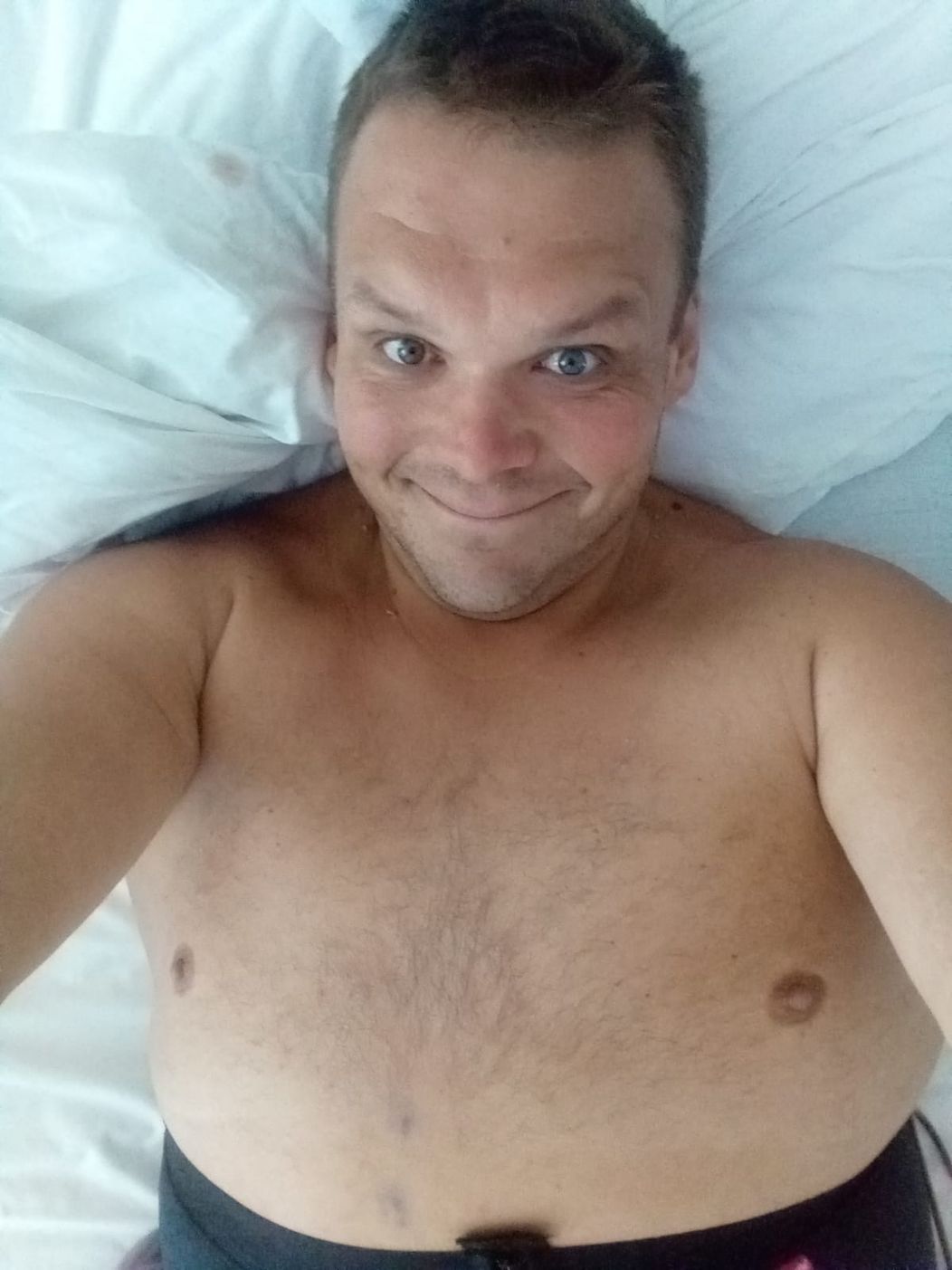 Andrej Baláž absolvoval po Extrémnych premenách úspešnú operáciu odstránenia nadbytku kože.