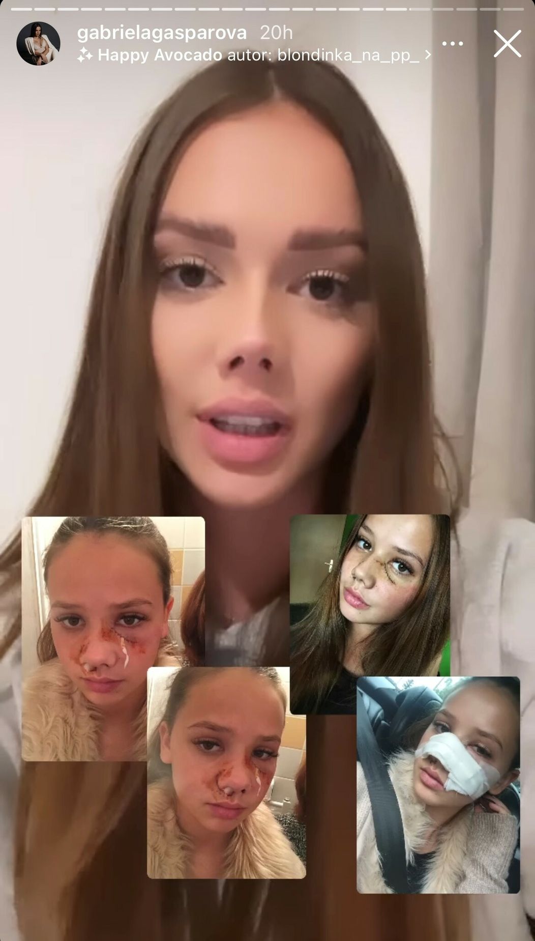 Gabriela ukázala hrozivé fotky po útoku psa.