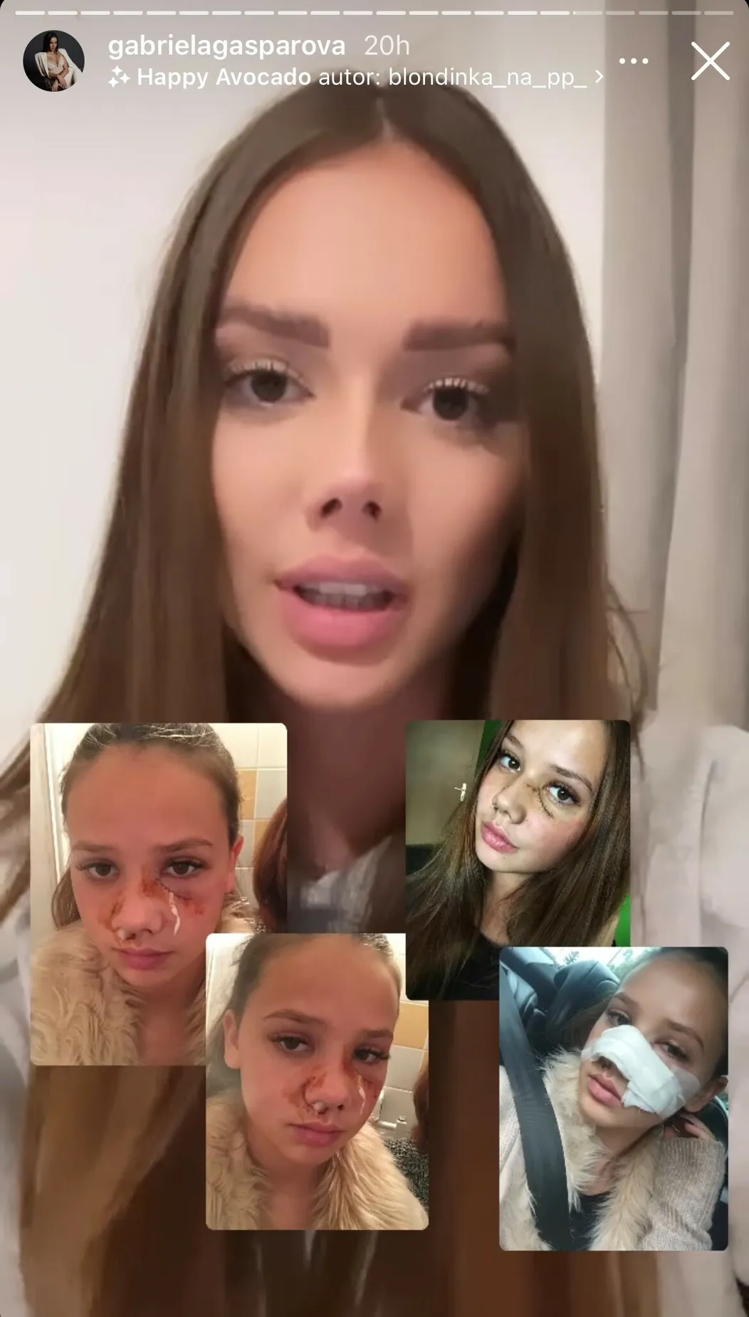 Gabriela ukázala hrozivé fotky po útoku psa.