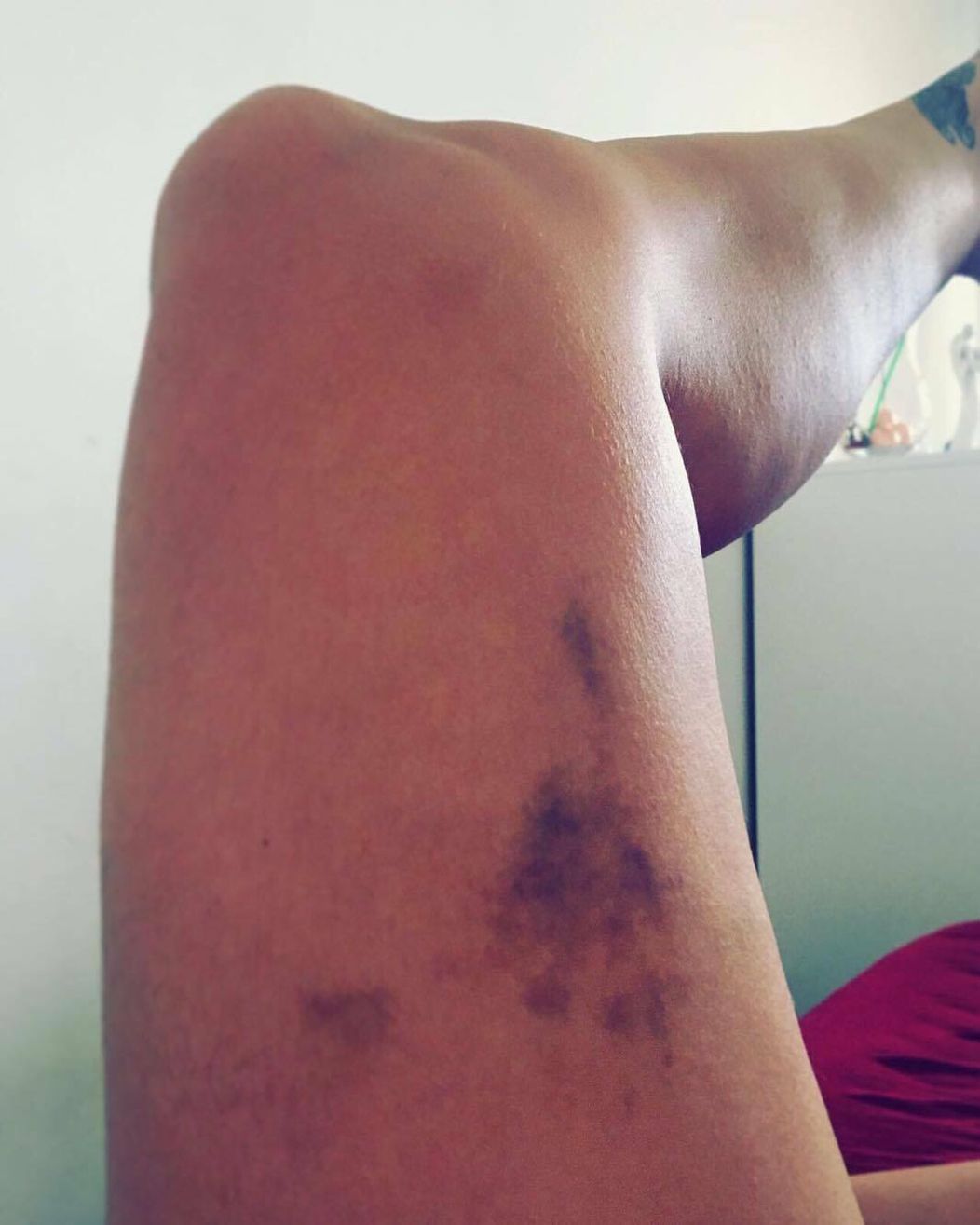 Takéto modriny si priniesla z legendárnej pevnosti