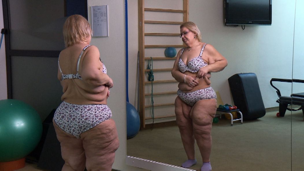 Pred operáciou mala Silvia mala o 80 kíl menej, no trápila ju ovisnutá koža