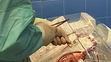 Transplantácia bijúceho srdca. 