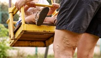 Krčové žily: Komu hrozia a ako sa im môžete vyhnúť