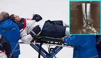 Sersen ukázal röntgenové snímky. Spolu so Šťastným sa budú liečiť mesiace