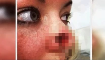 Žene po pravidelnej návšteve solária zostala v nose diera. Zistili jej rakovinu
