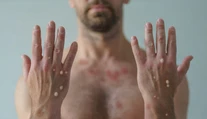 WHO mení názov opičích kiahní. Chce sa vyhnúť stigmatizácii