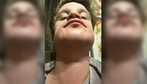 Žena chcela priateľovi natrieť bradu farbou na vlasy. Bizarný nápad skončil popáleninami