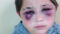 Podliatiny okolo očí a modriny na tele. Dobitého Ivanka (8) našli v zúboženom stave