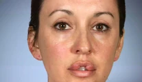 Desať rokov nezatvorila ústa. Chcela ich mať ako Angelina Jolie