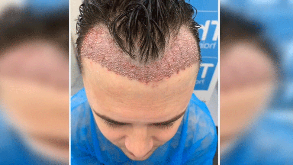 Na transplantáciu vlasov minul stovky libier. Zostala mu len zjazvená hlava