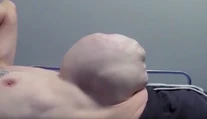 Musel žiť s obrovským pruhom. Bol veľký ako futbalová lopta