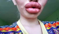 Dievča chcelo byť viac trendy. Dnes má také veľké pery, že ich nevie spojiť