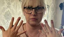 Žena roky nosila gélové nechty, teraz to horko ľutuje. Znetvorené prsty už takmer nedokáže ohnúť