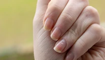 Biele škvrny či ryhy na nechtoch. Môžu poukazovať na nedostatok vitamínov, ale aj vážne ochorenia