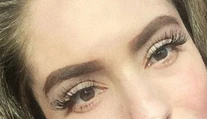 Česká YouTuberka, ktorá utrpela hrozivé popáleniny: Prvýkrát ukázala tvár
