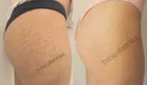 Takto by vám asi nenapadlo zbaviť sa strií. Nová metóda však naozaj funguje