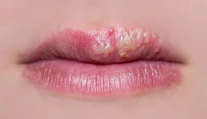 Z lekární i nemocníc sťahujú liek na herpes