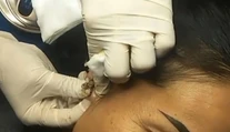 VIDEO: Lekár neveril vlastným očiam. Nenápadná vyrážka takmer poškodila žene ucho