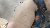 Mladík si do svalov pichal zmes. Z toho, čo v nich teraz mal, zostali lekári zdesení