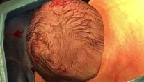 Fascinujúce zábery cisárskeho rezu. Dieťa sa samé predralo na svet