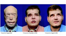 Plamene hasičovi znetvorili tvár, po 15 rokoch sa už môže usmievať