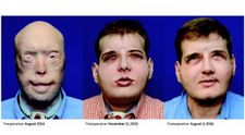 Plamene hasičovi znetvorili tvár, po 15 rokoch sa už môže usmievať