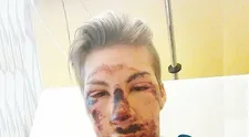 VIDEO: Hrôzostrašný pád počas tréningu. Rakúsky skokan na lyžiach sa druhýkrát narodil