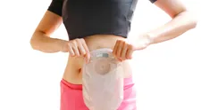 Tínedžerka (16) sa pokúšala o skupinový análny sex. Do konca života bude mať vývod