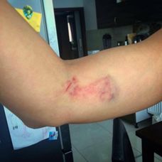 Takéto modriny si Mamba priniesla z legendárnej pevnosti