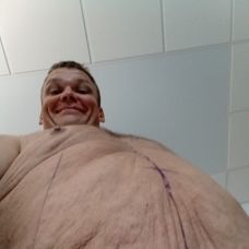 Andrej Baláž absolvoval po Extrémnych premenách úspešnú operáciu odstránenia nadbytku kože.