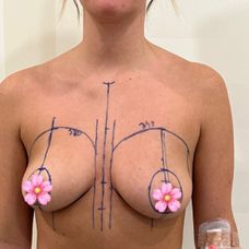 Tereza po plastickej operácii