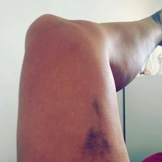 Takéto modriny si priniesla z legendárnej pevnosti