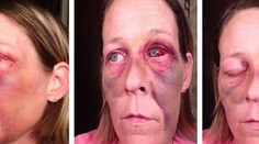 Takto má vyzerať láska? Selfie dobitej ženy má jasný odkaz