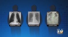 Porovnanie snímok pľúc je šokujúce: Po-covidové sú oveľa horšie ako pľúca tuhých fajčiarov