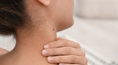 Znamienka, jazvy a pigmentové škvrny v lete. Dermatologička vysvetľuje, ako ich chrániť pred slnečným žiarením