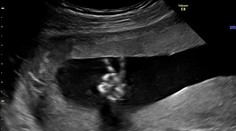 Dvadsaťtýždňové bábo poslalo rodičom z bruška radostný odkaz