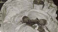Unikátny zákrok. Lekár si musel slepé črevo operovať sám