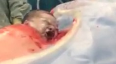 Autentické zábery z prirodzeného cisárskeho rezu. Dieťa sa prediera na svet samé