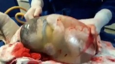 Vzácne video z pôrodu. Dieťa sa narodilo v neporušenom plodovom vaku