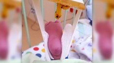 Záhadná zlomenina. Nemocnica tvrdí, že novorodenec si privodil zranenie sám