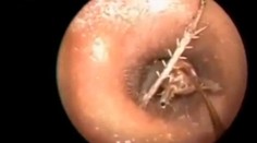 Muža strašne svrbelo ucho. Neuveríte, čo mu lekár z neho vytiahol